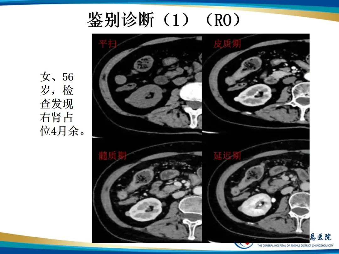 【PPT】肾细胞癌-16