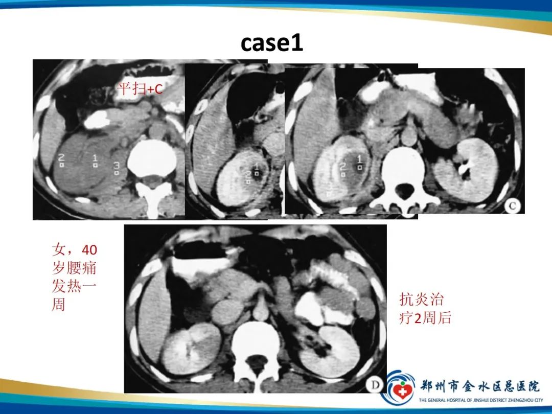 【PPT】肾细胞癌-21