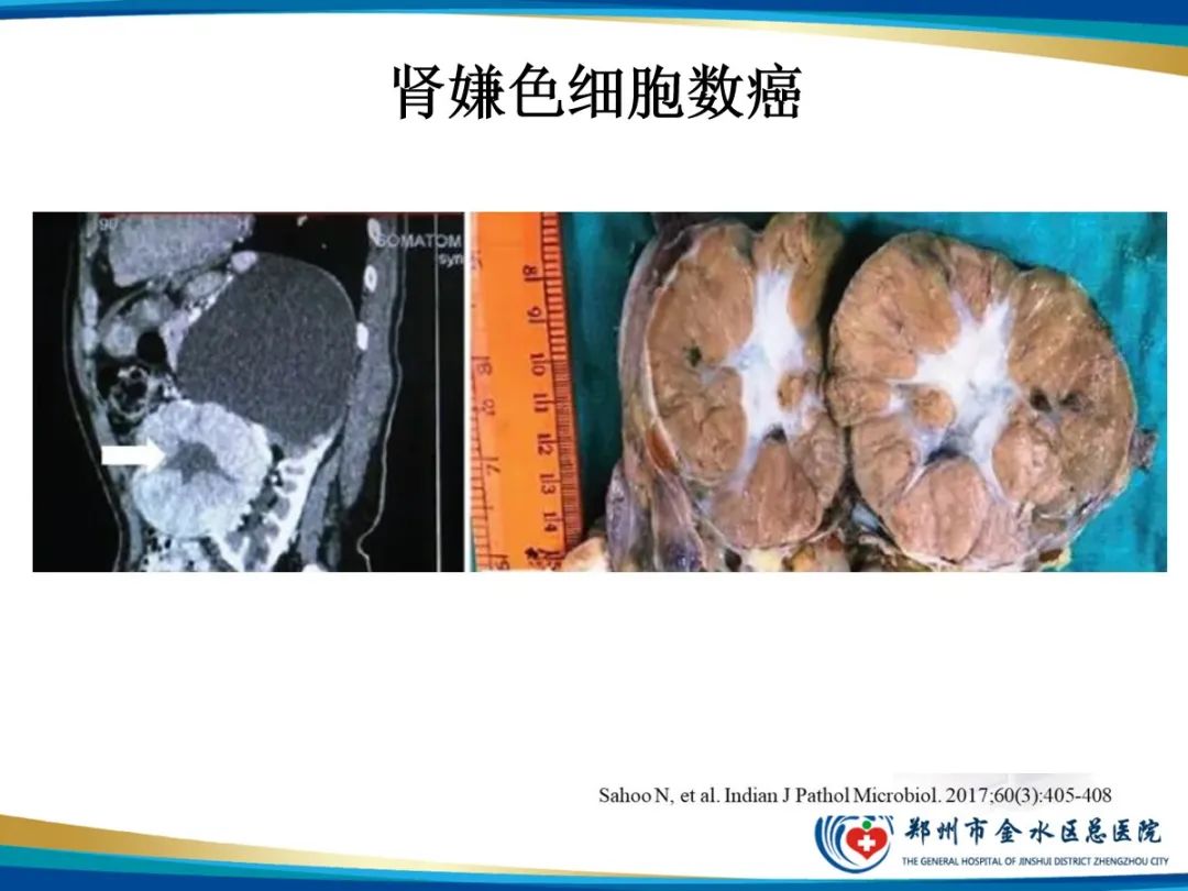 【PPT】肾细胞癌-13