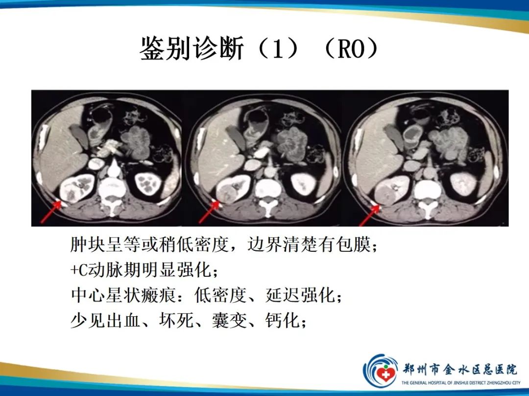 【PPT】肾细胞癌-17