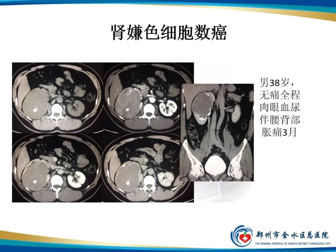 【PPT】肾细胞癌-14