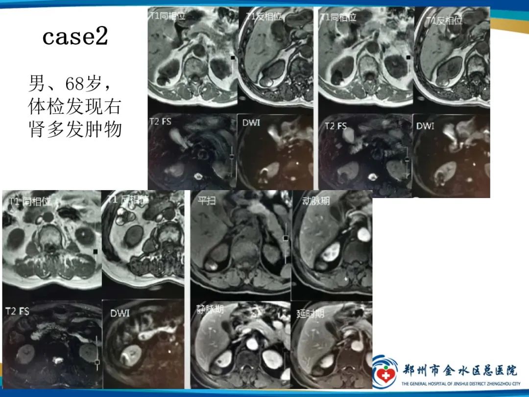 【PPT】肾细胞癌-11