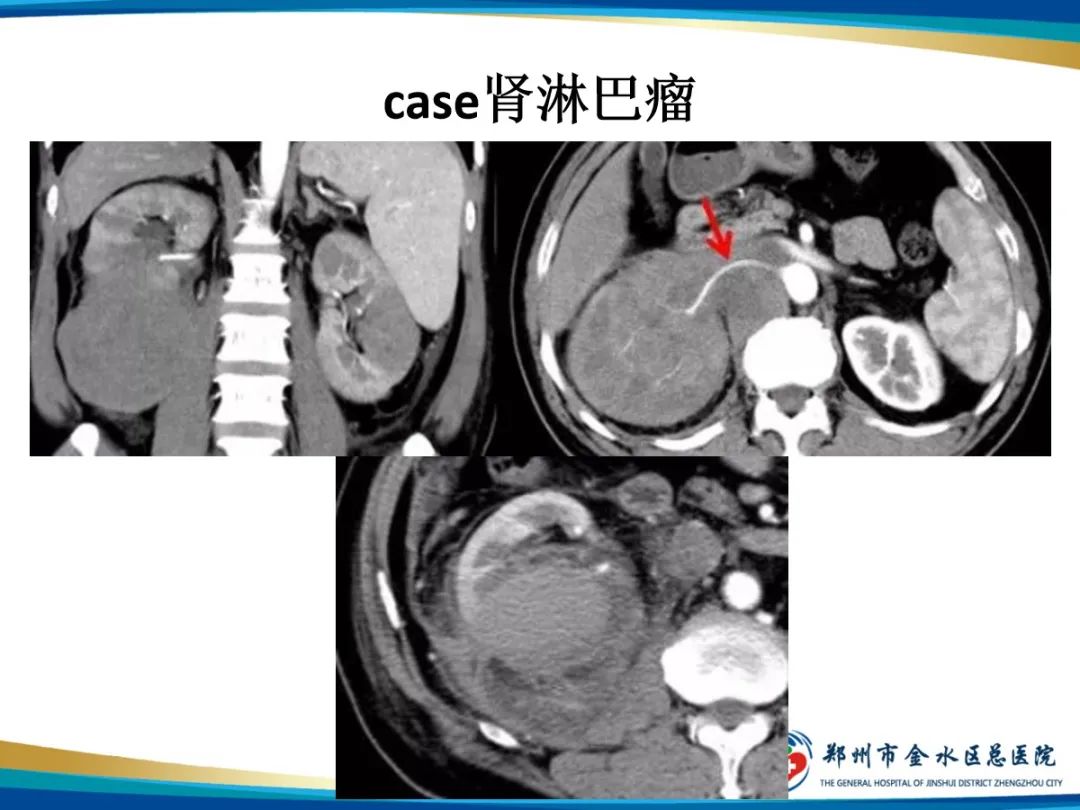 【PPT】肾细胞癌-23