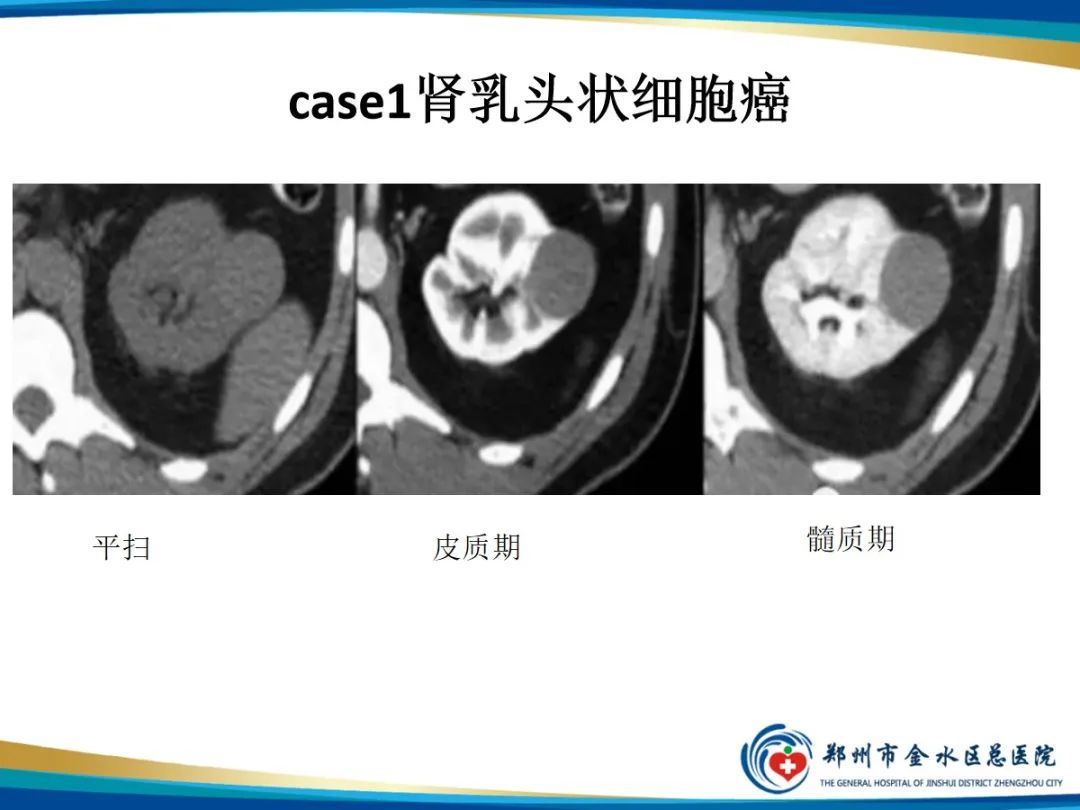 【PPT】肾细胞癌-10