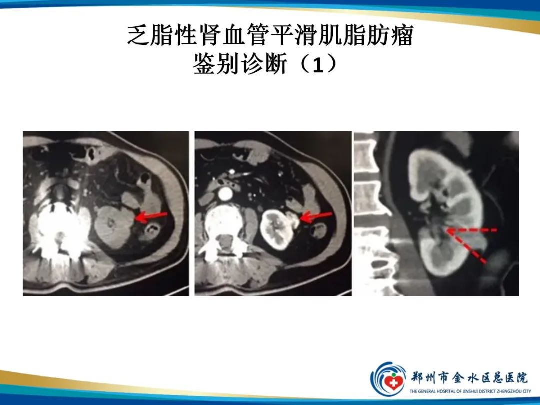 【PPT】肾细胞癌-8