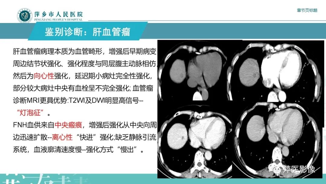 【PPT】肝脏局灶性结节性增生(FNH)-22