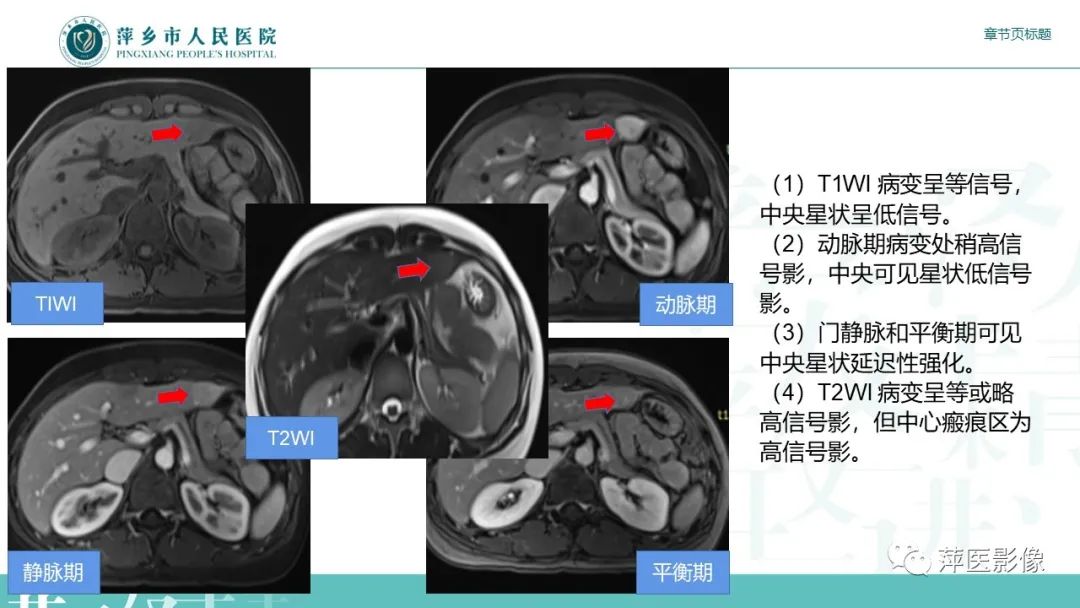 【PPT】肝脏局灶性结节性增生(FNH)-16