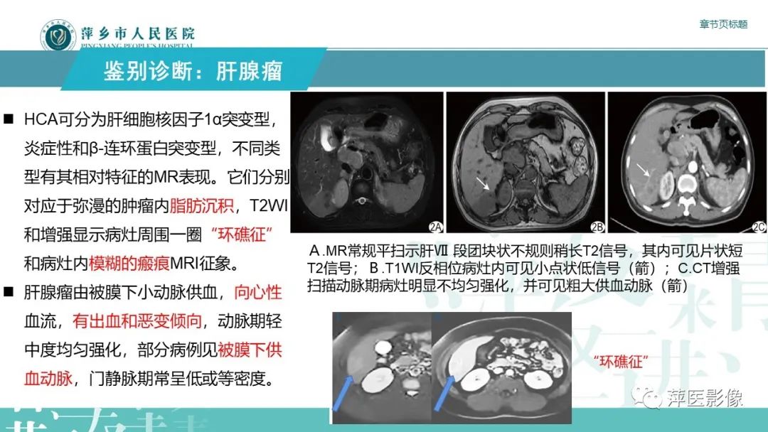 【PPT】肝脏局灶性结节性增生(FNH)-21