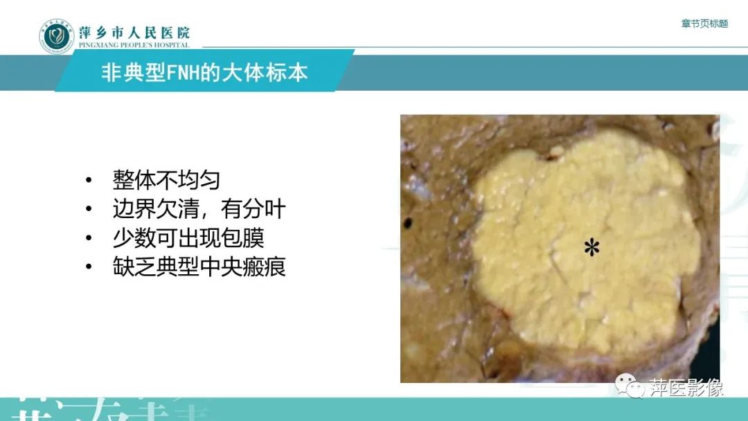 【PPT】肝脏局灶性结节性增生(FNH)-11