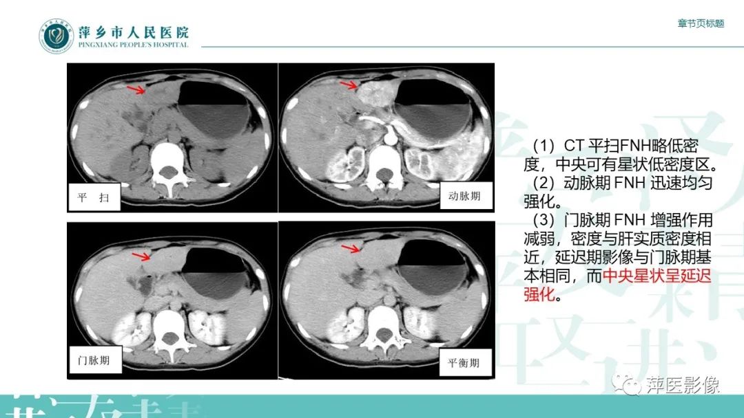 【PPT】肝脏局灶性结节性增生(FNH)-14