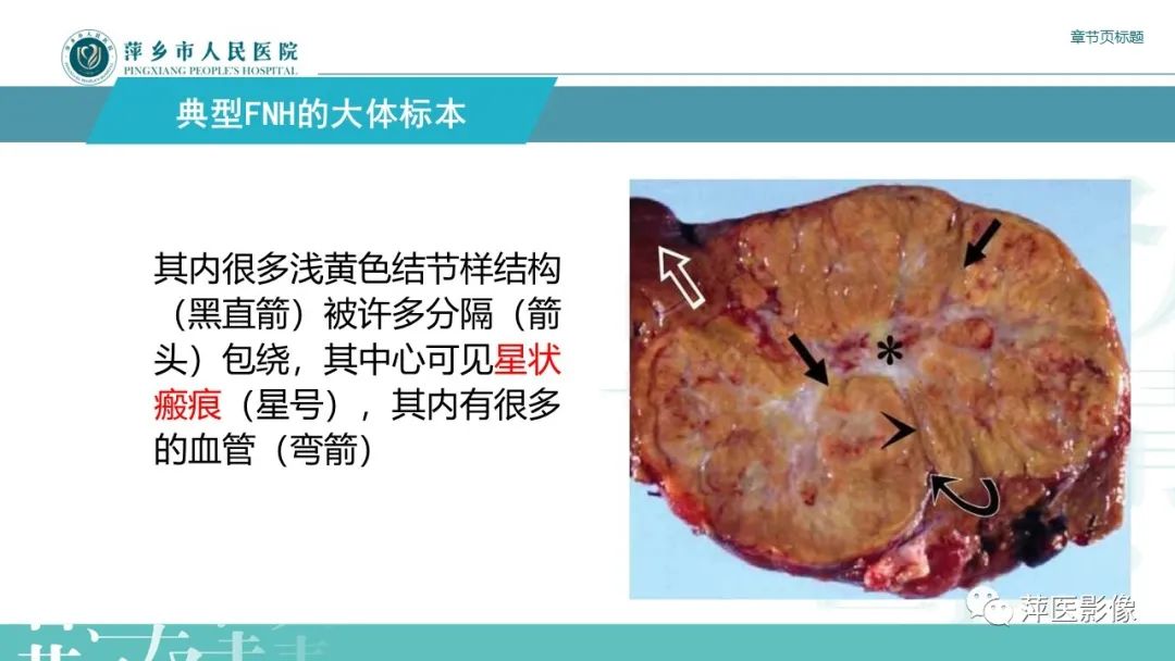 【PPT】肝脏局灶性结节性增生(FNH)-9