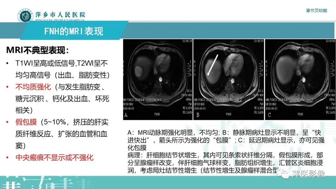 【PPT】肝脏局灶性结节性增生(FNH)-17