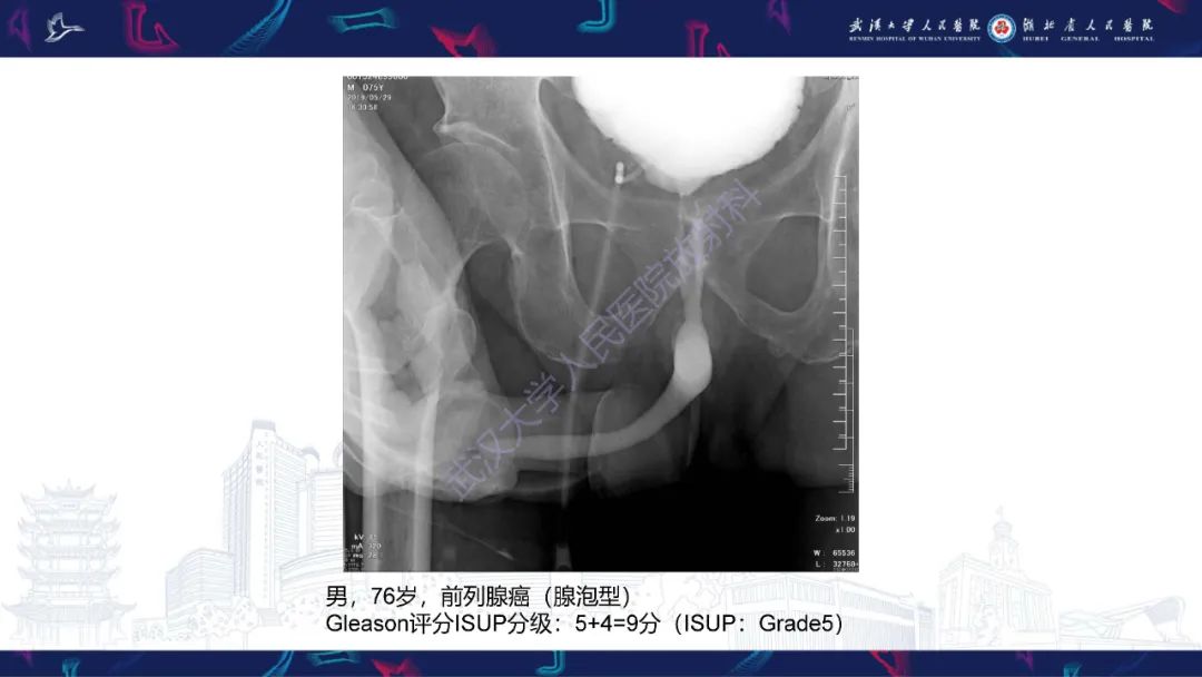 【PPT】尿道造影疾病诊断-54