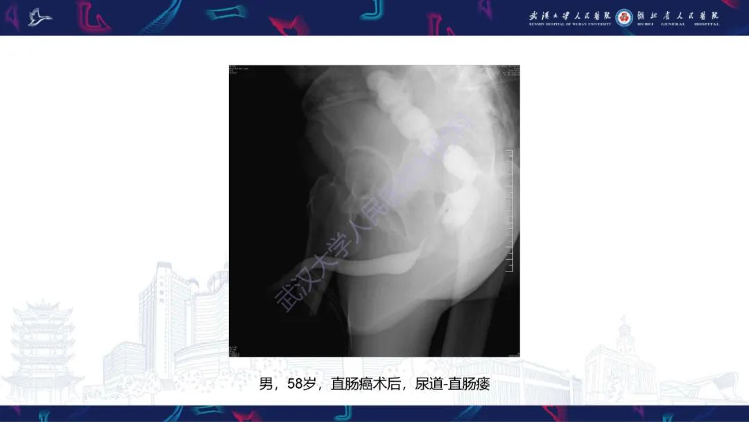 【PPT】尿道造影疾病诊断-40