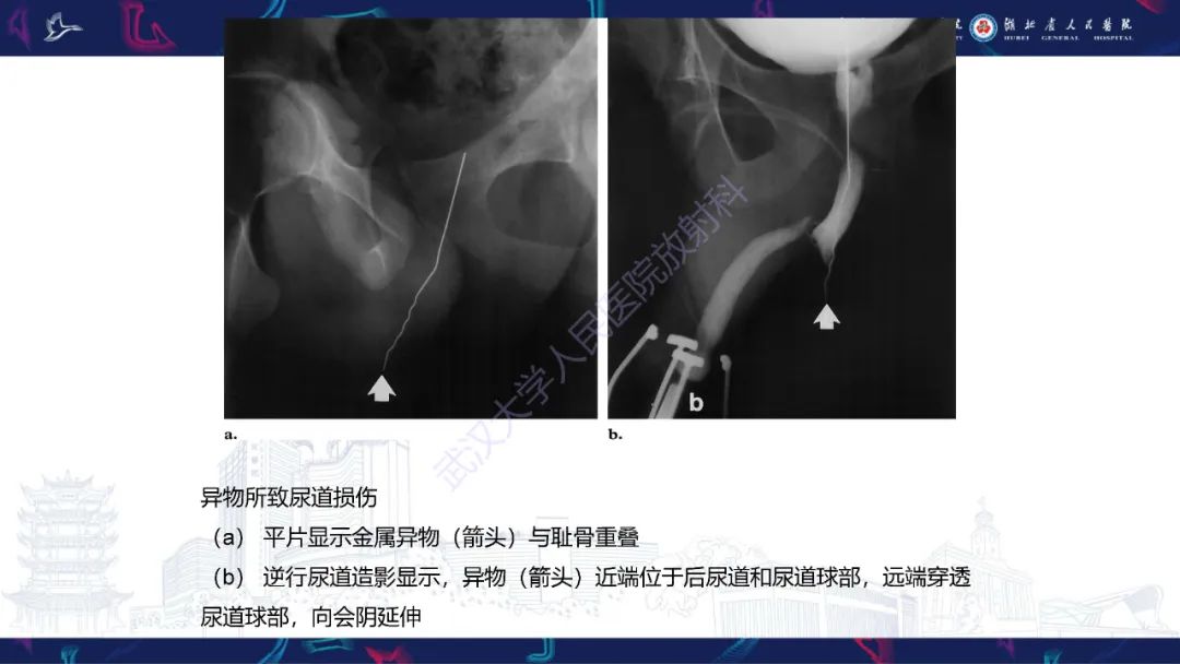 【PPT】尿道造影疾病诊断-35