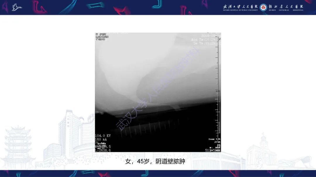 【PPT】尿道造影疾病诊断-46