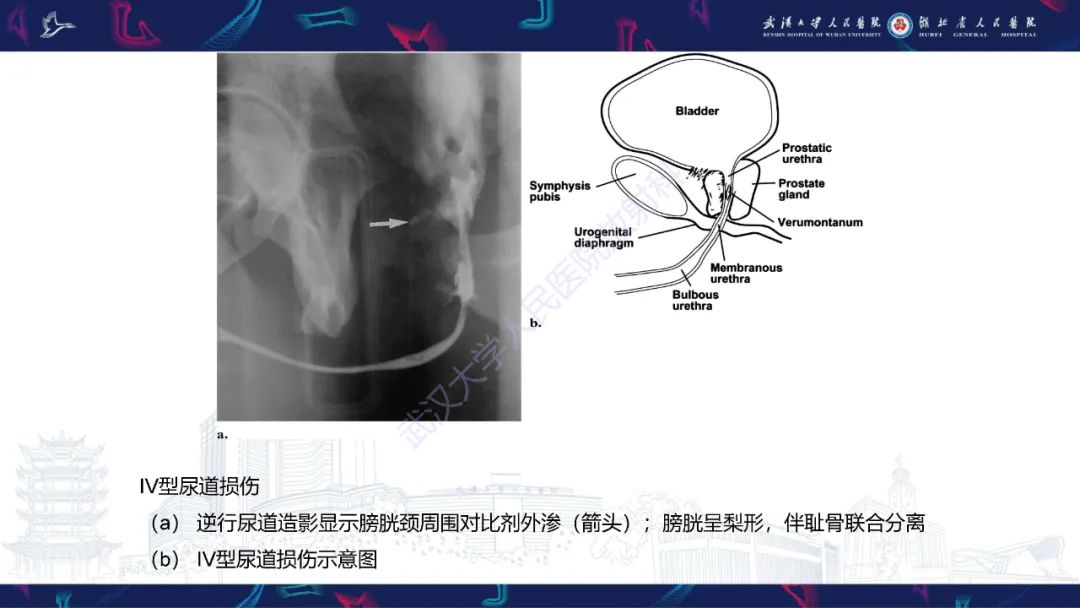 【PPT】尿道造影疾病诊断-28