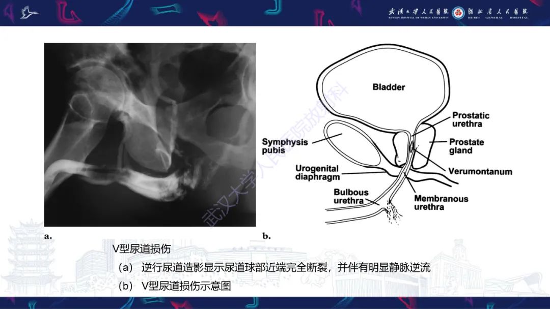 【PPT】尿道造影疾病诊断-30
