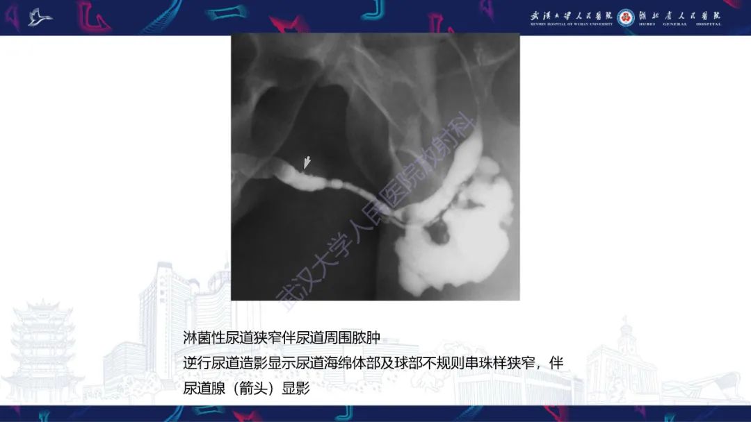 【PPT】尿道造影疾病诊断-44