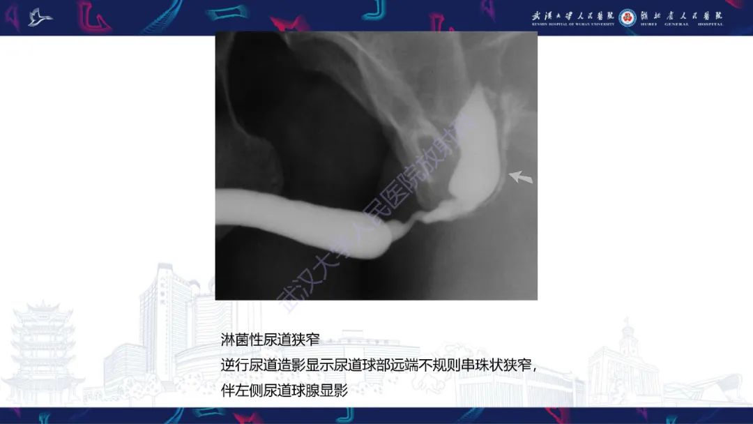 【PPT】尿道造影疾病诊断-43