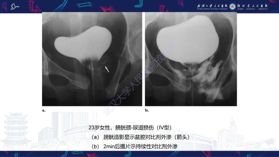 【PPT】尿道造影疾病诊断-32