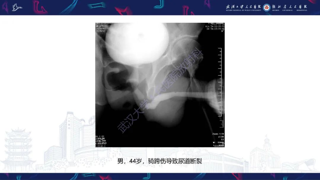 【PPT】尿道造影疾病诊断-24