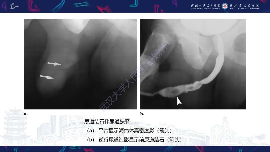 【PPT】尿道造影疾病诊断-50