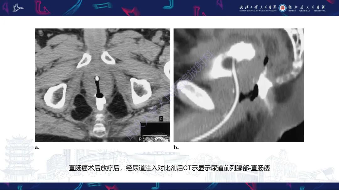 【PPT】尿道造影疾病诊断-39