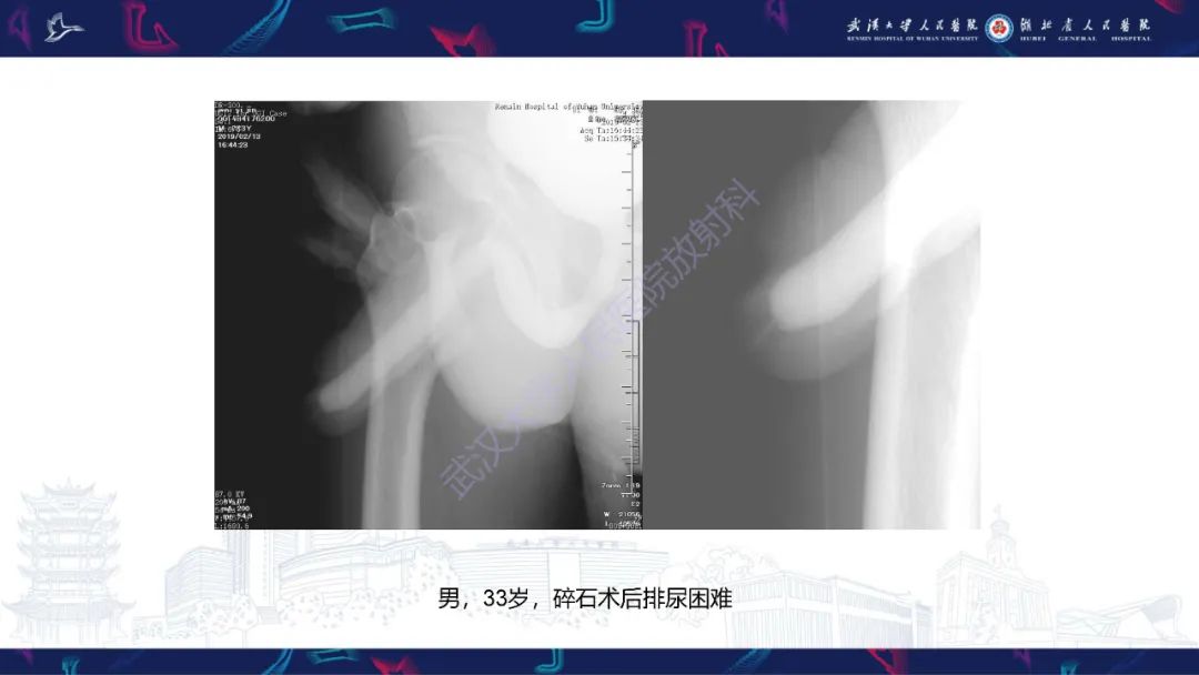 【PPT】尿道造影疾病诊断-51