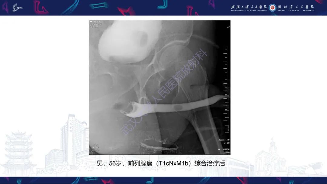 【PPT】尿道造影疾病诊断-55