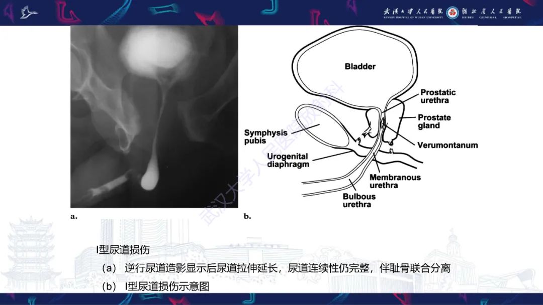 【PPT】尿道造影疾病诊断-19
