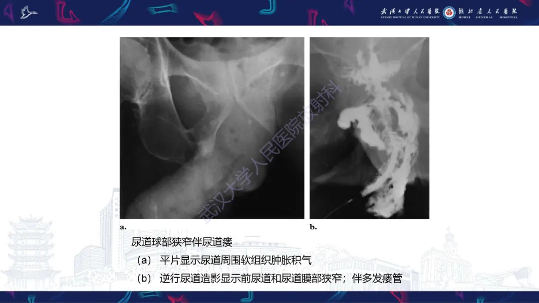【PPT】尿道造影疾病诊断-45
