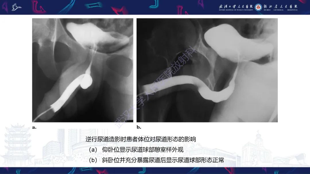 【PPT】尿道造影疾病诊断-13