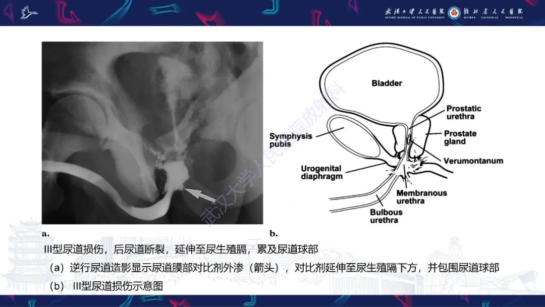 【PPT】尿道造影疾病诊断-23