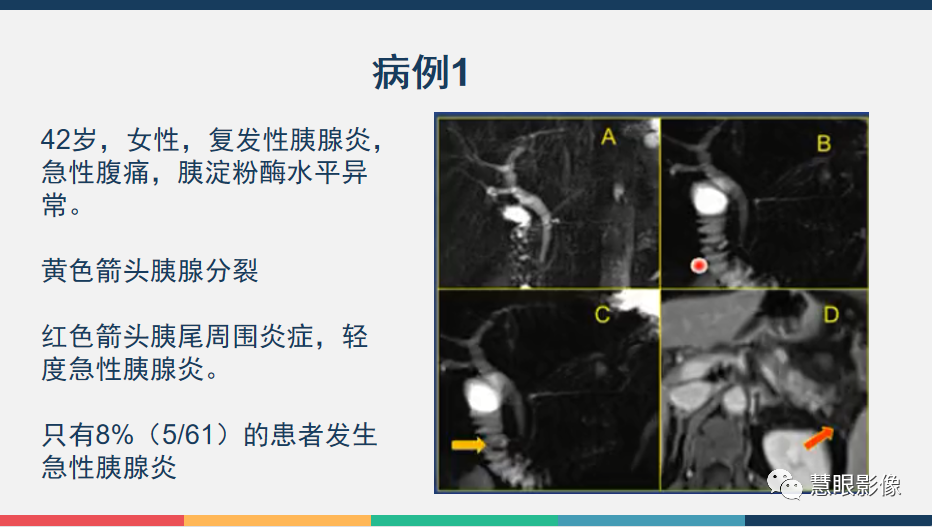 【PPT】胰腺解剖变异、发育异常及相关病变影像评估-22