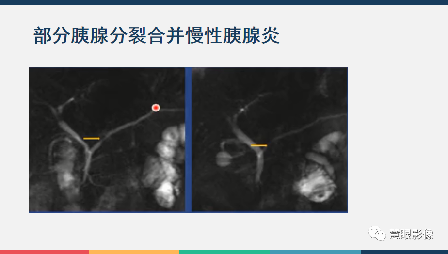 【PPT】胰腺解剖变异、发育异常及相关病变影像评估-19