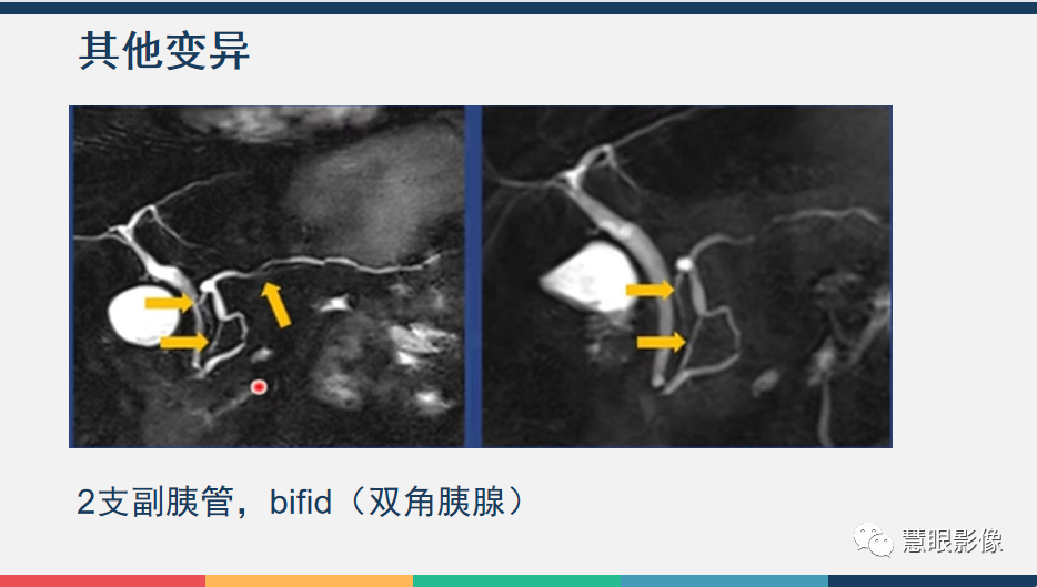 【PPT】胰腺解剖变异、发育异常及相关病变影像评估-10