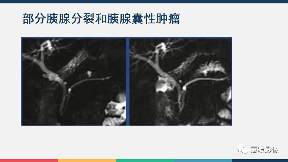 【PPT】胰腺解剖变异、发育异常及相关病变影像评估-18