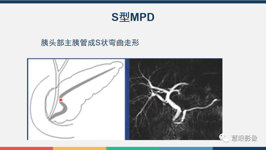 【PPT】胰腺解剖变异、发育异常及相关病变影像评估-9