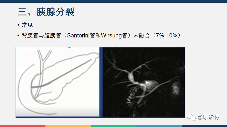 【PPT】胰腺解剖变异、发育异常及相关病变影像评估-14