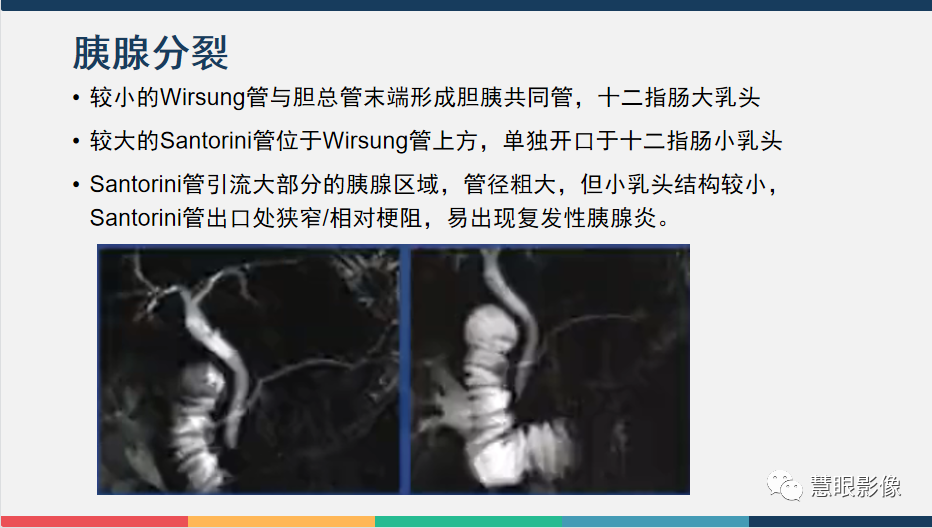 【PPT】胰腺解剖变异、发育异常及相关病变影像评估-15