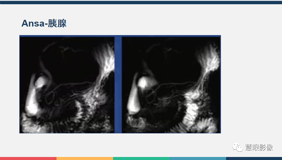 【PPT】胰腺解剖变异、发育异常及相关病变影像评估-12