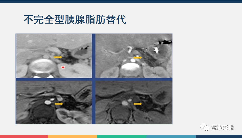 【PPT】胰腺解剖变异、发育异常及相关病变影像评估-30