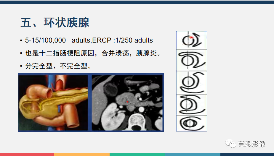 【PPT】胰腺解剖变异、发育异常及相关病变影像评估-23