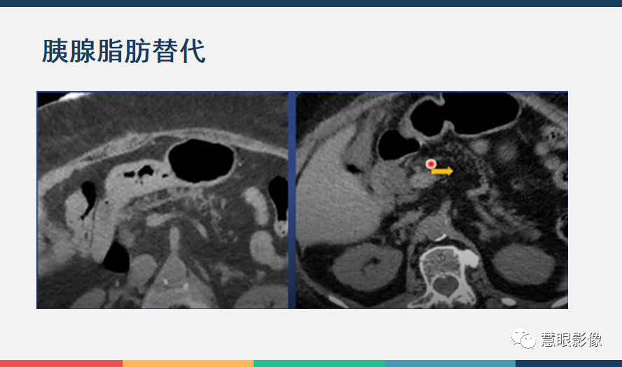 【PPT】胰腺解剖变异、发育异常及相关病变影像评估-32