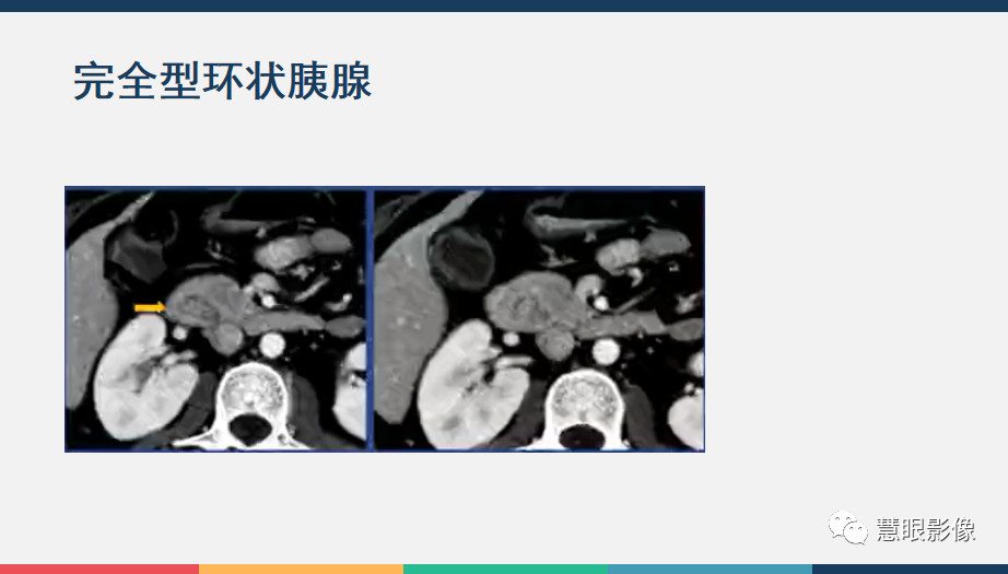 【PPT】胰腺解剖变异、发育异常及相关病变影像评估-25