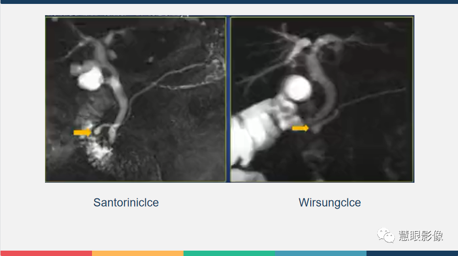【PPT】胰腺解剖变异、发育异常及相关病变影像评估-21
