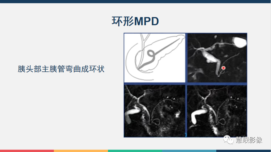 【PPT】胰腺解剖变异、发育异常及相关病变影像评估-8