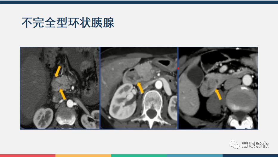 【PPT】胰腺解剖变异、发育异常及相关病变影像评估-24