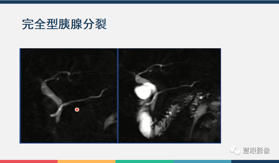 【PPT】胰腺解剖变异、发育异常及相关病变影像评估-16